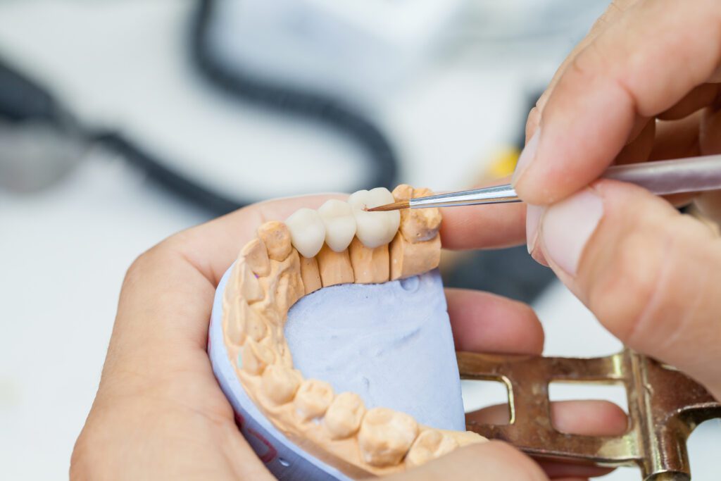 dental bridges