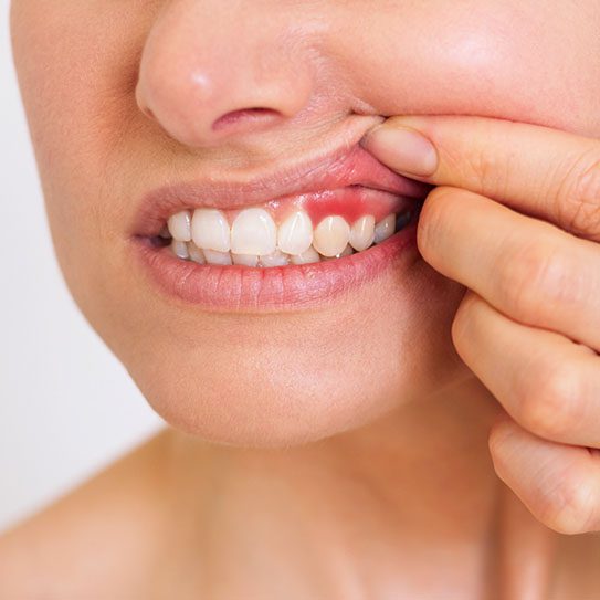 dental clinic in Snellville gum disease