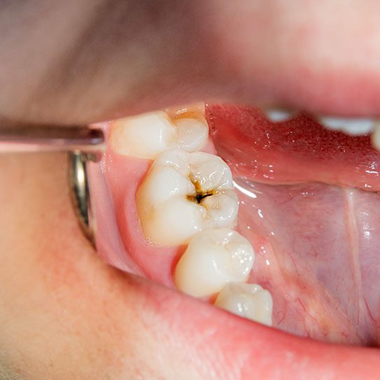 dentist near me cavities