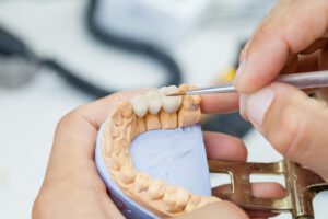dental implant vs. dental bridge