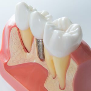 dental implant crown